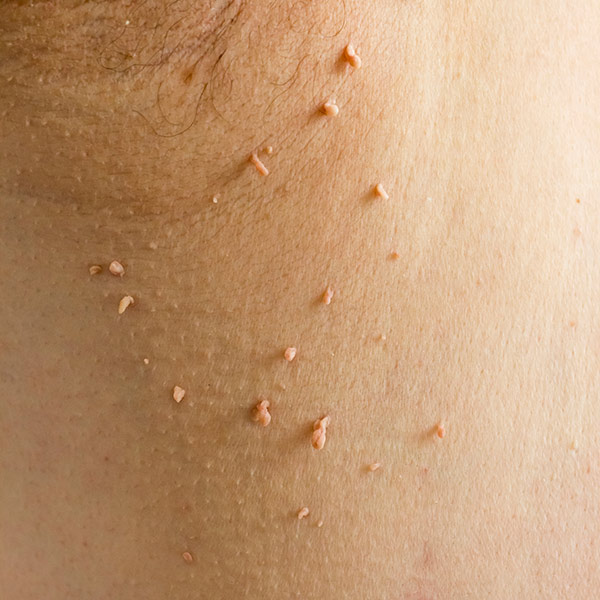 Skin Tags