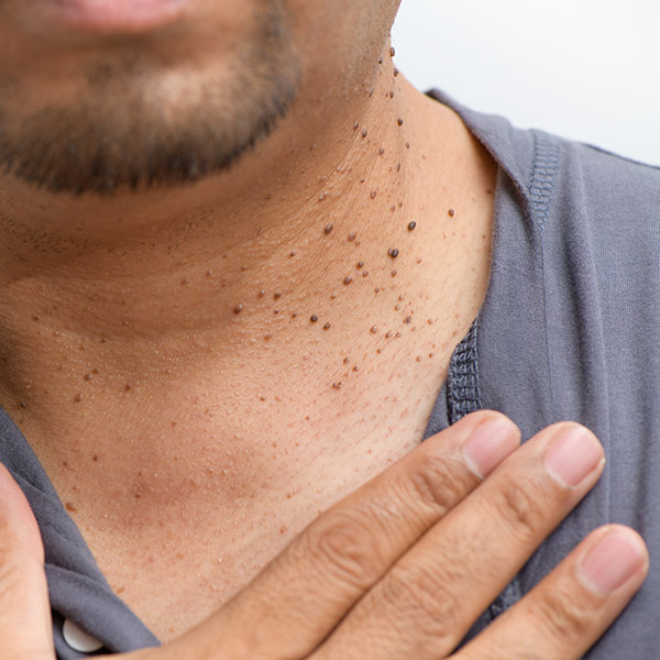 Skin Tags