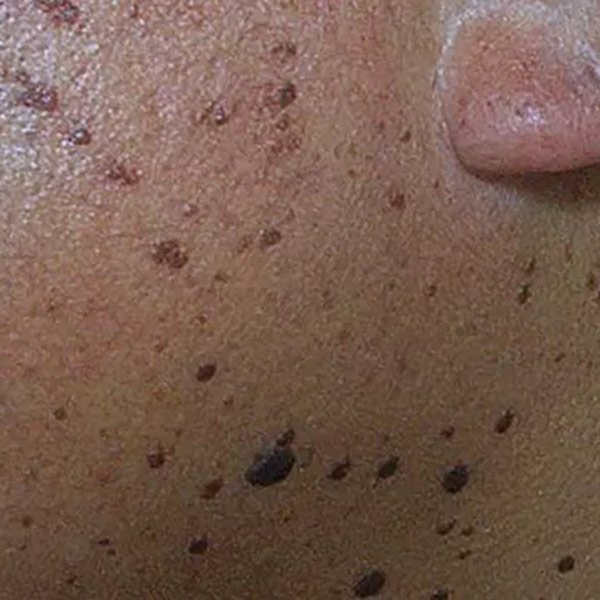 Dermatosis Papulosa Nigra (DPN)