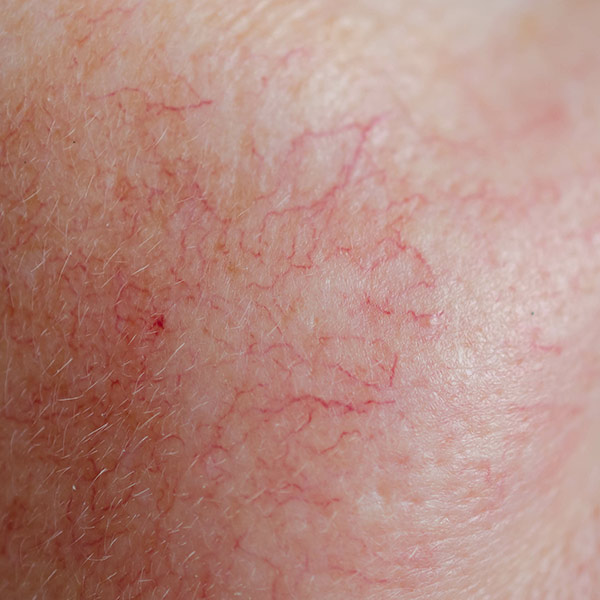 Spider Veins (Telangiectasia)