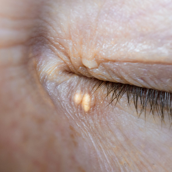 Xanthelasma