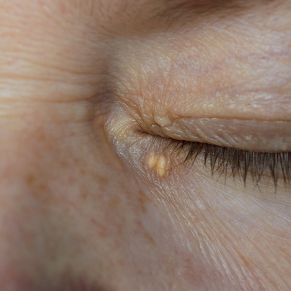 Xanthelasma