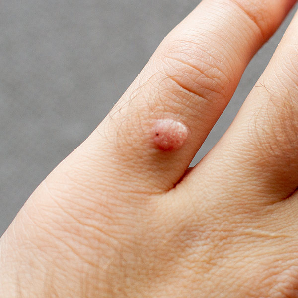 Common Warts