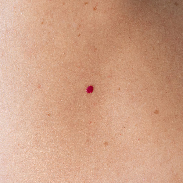 Cherry Angiomas
