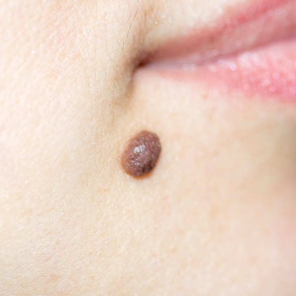 Moles