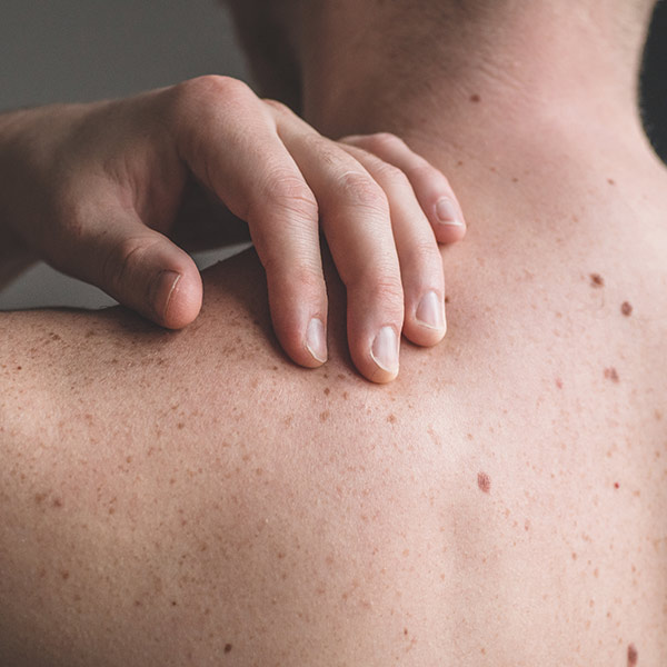 Moles