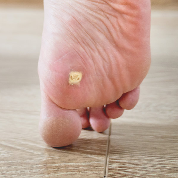 Verrucas (Plantar Warts)