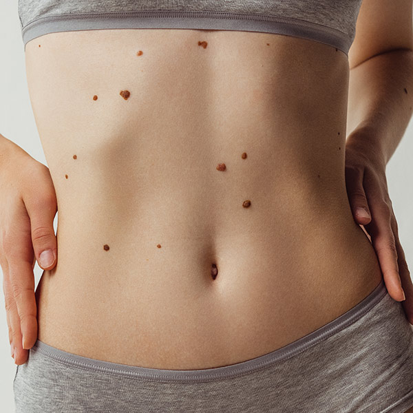 Moles