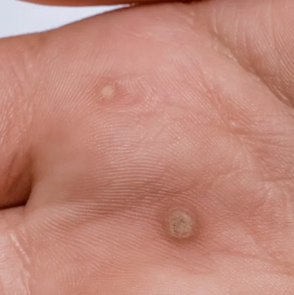Common Warts