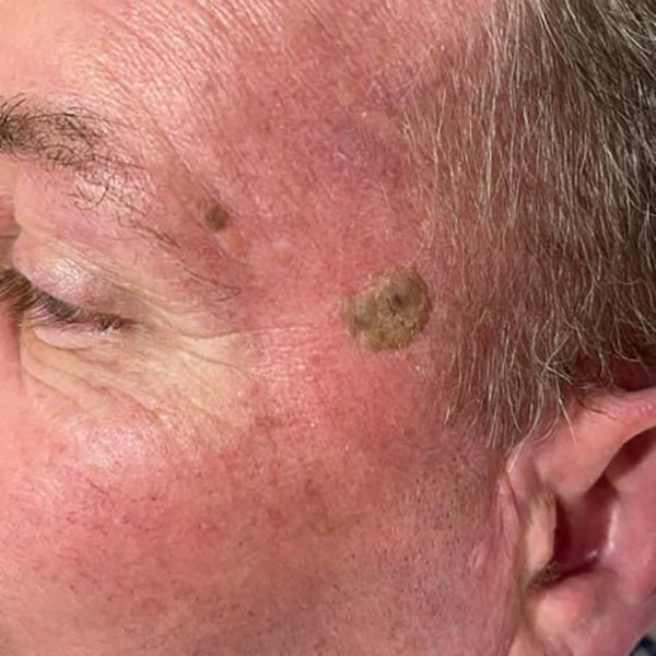 Seborrheic Keratosis
