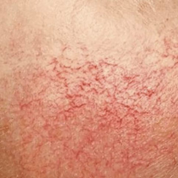 Spider Veins (Telangiectasia)