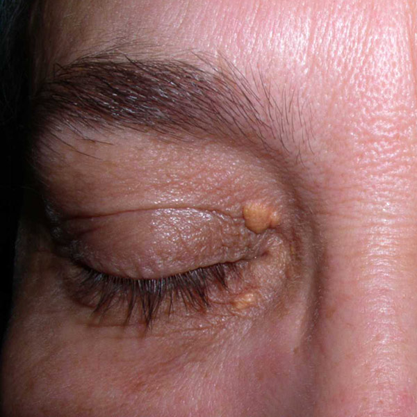 Xanthelasma
