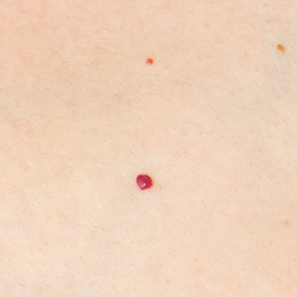Cherry Angiomas