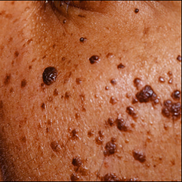 Dermatosis Papulosa Nigra (DPN)