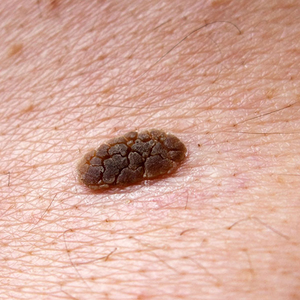 Seborrheic Keratosis