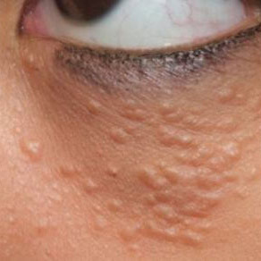 Syringoma