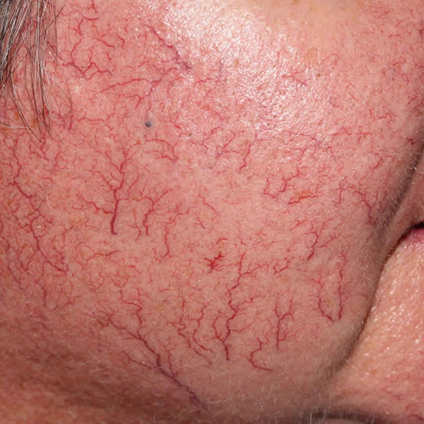 Spider Veins (Telangiectasia)