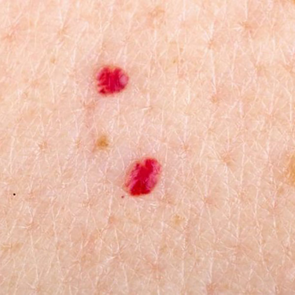 Cherry Angiomas